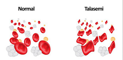 Talasemi Resmi